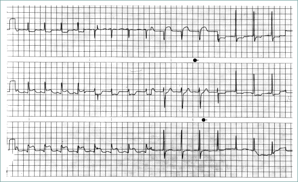 Figure 2.2-1. Myocardial infarction.