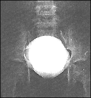 рентгенограмма больного с пузырно-мочеточниковым рефлюксом 1 степени