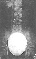 рентгенограмма больного с пузырно-мочеточниковым рефлюксом 2 степени