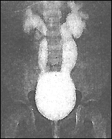 рентгенограмма больного с пузырно-мочеточниковым рефлюксом 4 степени