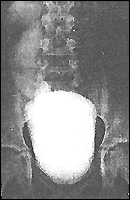 рентгенограмма больного с пузырно-мочеточниковым рефлюксом 5 степени