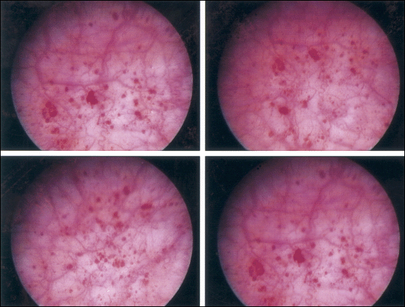 Typical appearance of Hunner's ulcer in a patient with interstitial cystitis before bladder distention