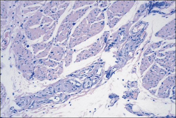 Detrusor mastocytosis and nerve hypertrophy in interstitial cystitis