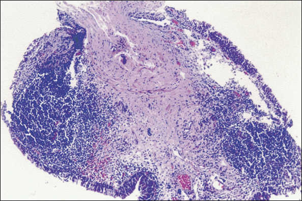 Nonulcerative form of interstitial cystitis with dense lymphoid infiltrate in the lamina propria